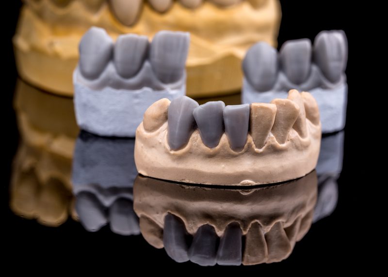 Diagnostic wax up — dental treatment planning
